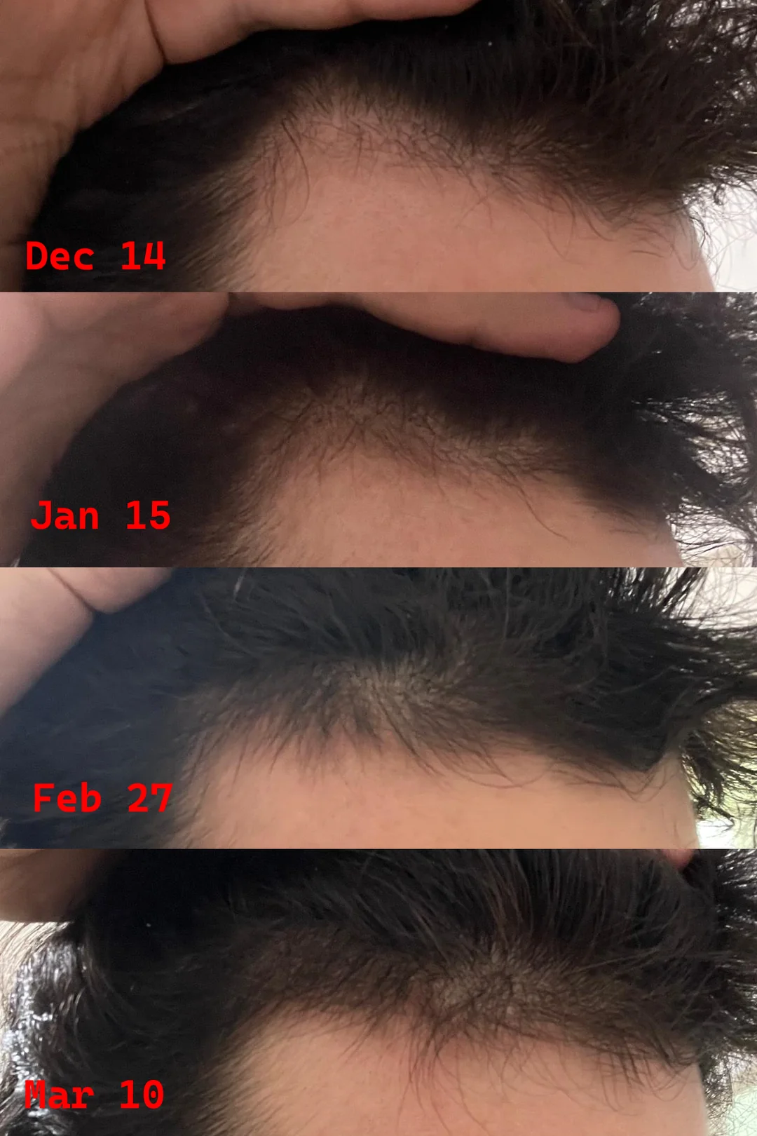 3 months of Minoxidil 5% use