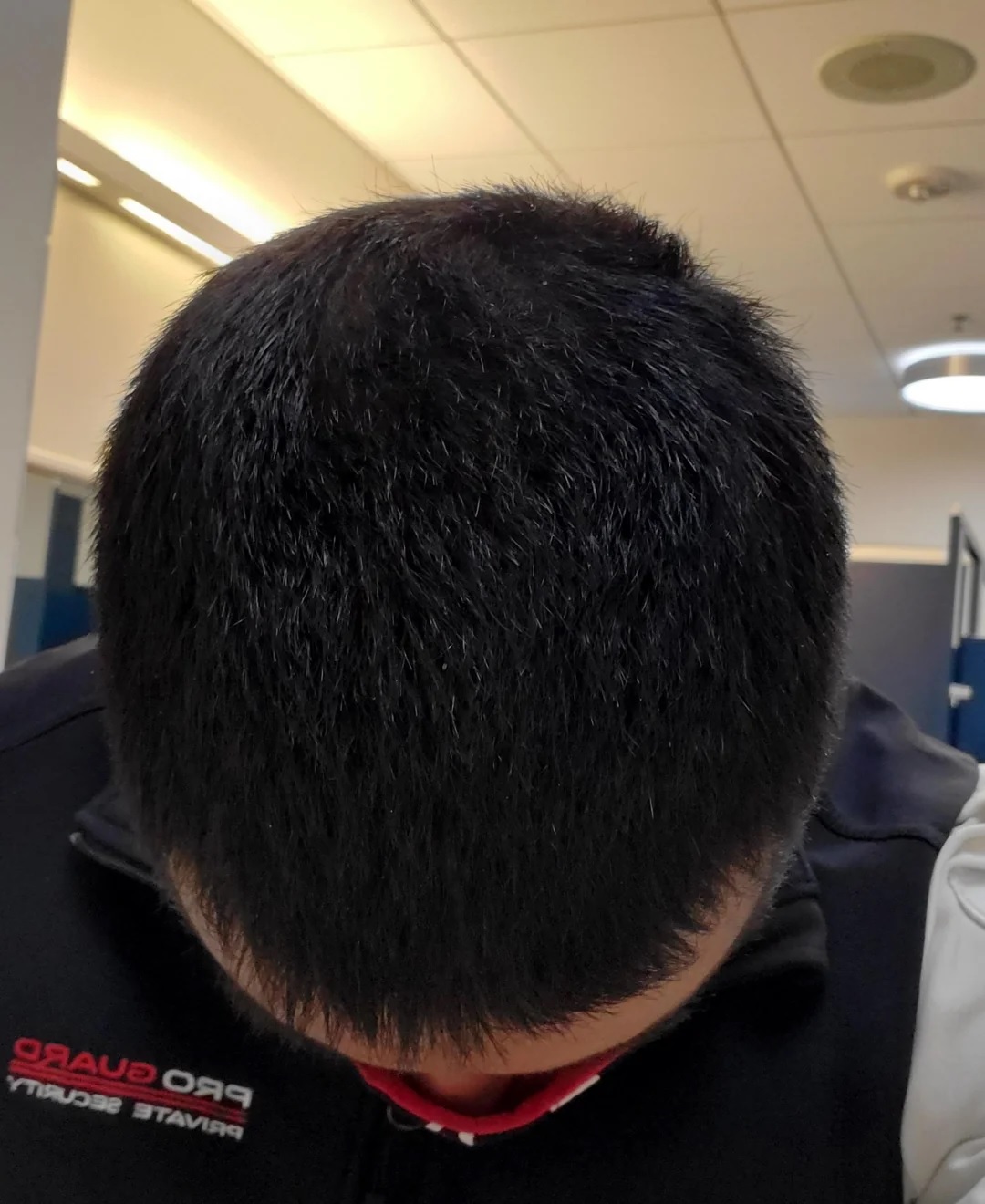 After 3 months of Minoxidil 5% use