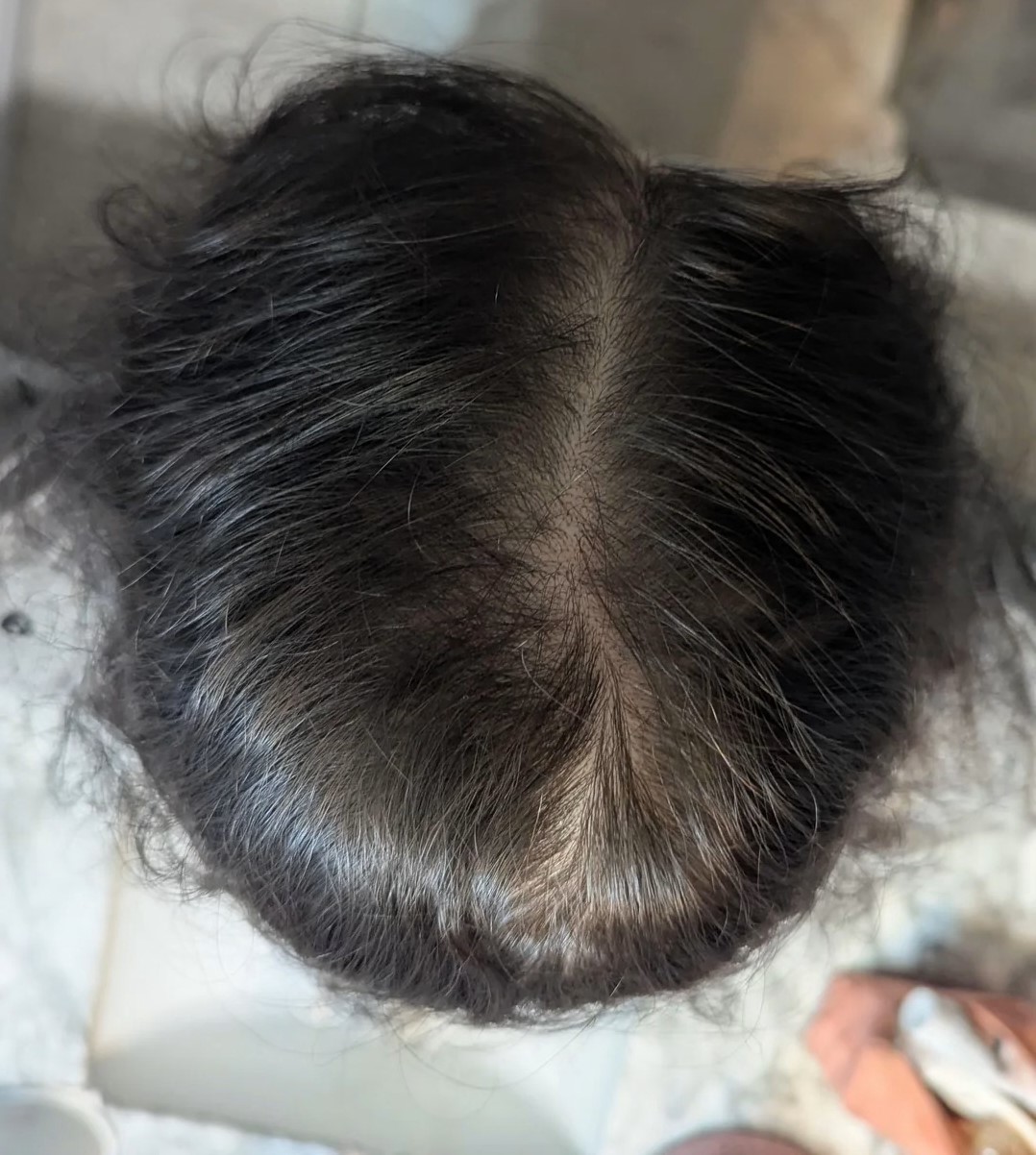 After 9 months of Minoxidil 5% and other treatments