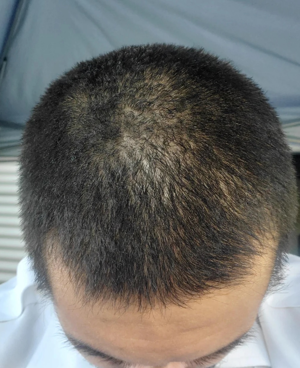 Before 3 months of Minoxidil 5% use