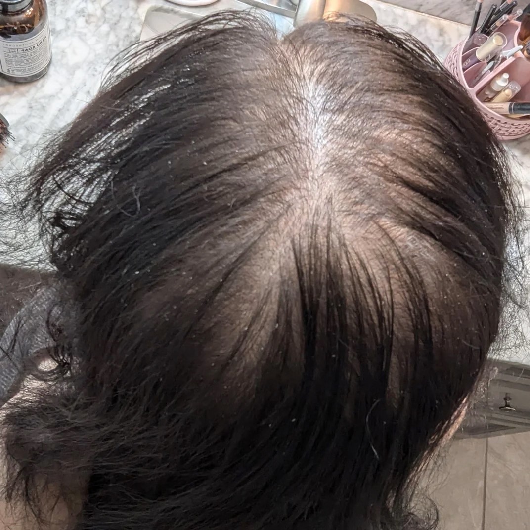 Before 9 months of Minoxidil 5% and other treatments